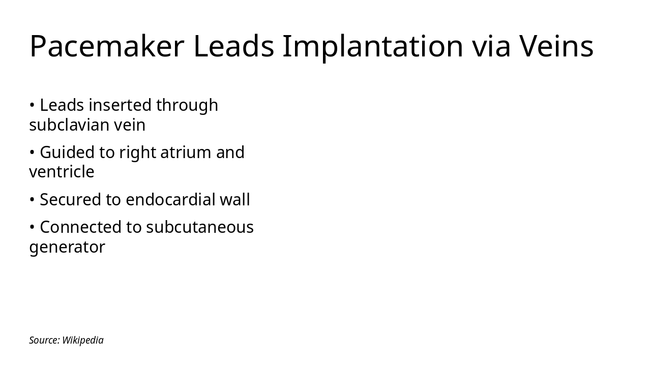 Slide 6 - Pacemaker Leads Implantation via Veins
