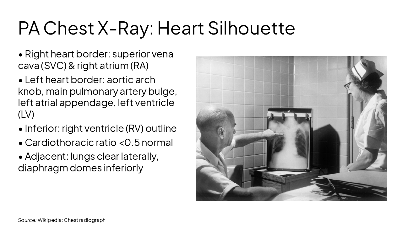 Slide 3 - PA Chest X-Ray: Heart Silhouette